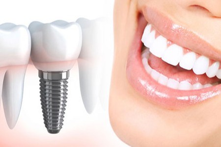 شایع ترین تفاوت های ایمپلنت دندان و کامپوزیت دندان