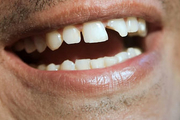 دلیل شکستن دندان چیست؟