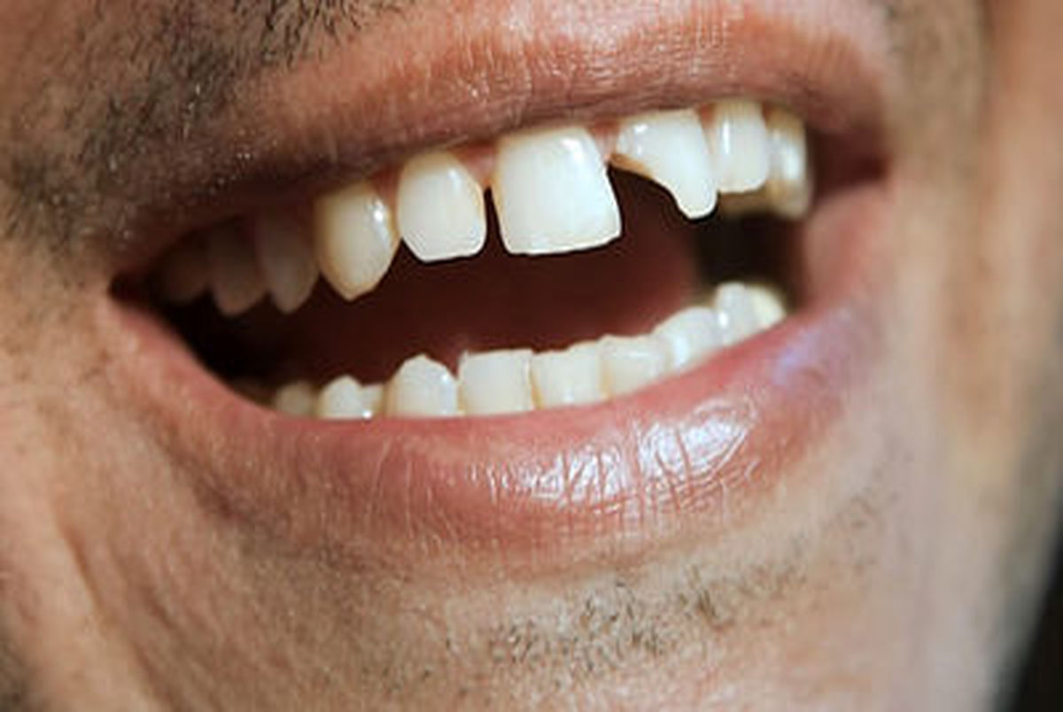 دلیل شکستن دندان چیست؟