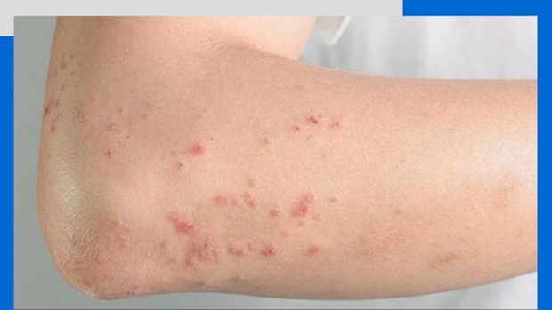 آنچه باید درباره سرطان پوستی ملانوم بدانید
