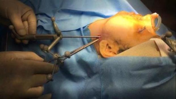 عمل'جراحی ناوبری' برای خارج کردن جسم خارجی از گردن بیمار در اصفهان
انجام شد
