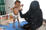 تصاویر اسفناکی از گرسنگی در یمن