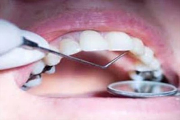 درمان پالپ زنده دندان برای 640 نفر در قزوین انجام شد