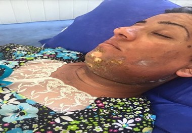 آمار مصدومان حملات شیمیایی داعش در موصل 