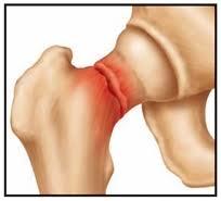 ارتباط مصرف زیاد ویتامین B و شکستگی استخوان لگن