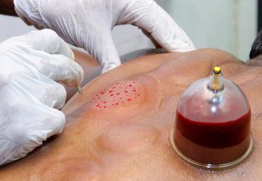 بایدها و نبایدهای حجامت