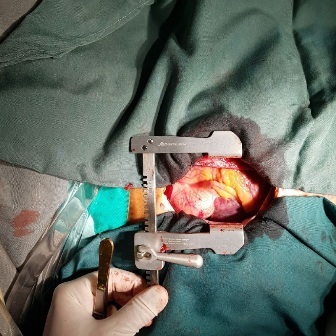 عمل جراحی نقص دیواره بین بطنی بر روی قلب کودک 11 ساله در قزوین انجام شد