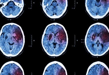 سکته مغزی زیر ذره‌بین محققان ایرانی

