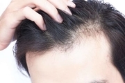 درمان ریزش مو با آب پیاز+نکاتی برای افزایش اثربخشی 

