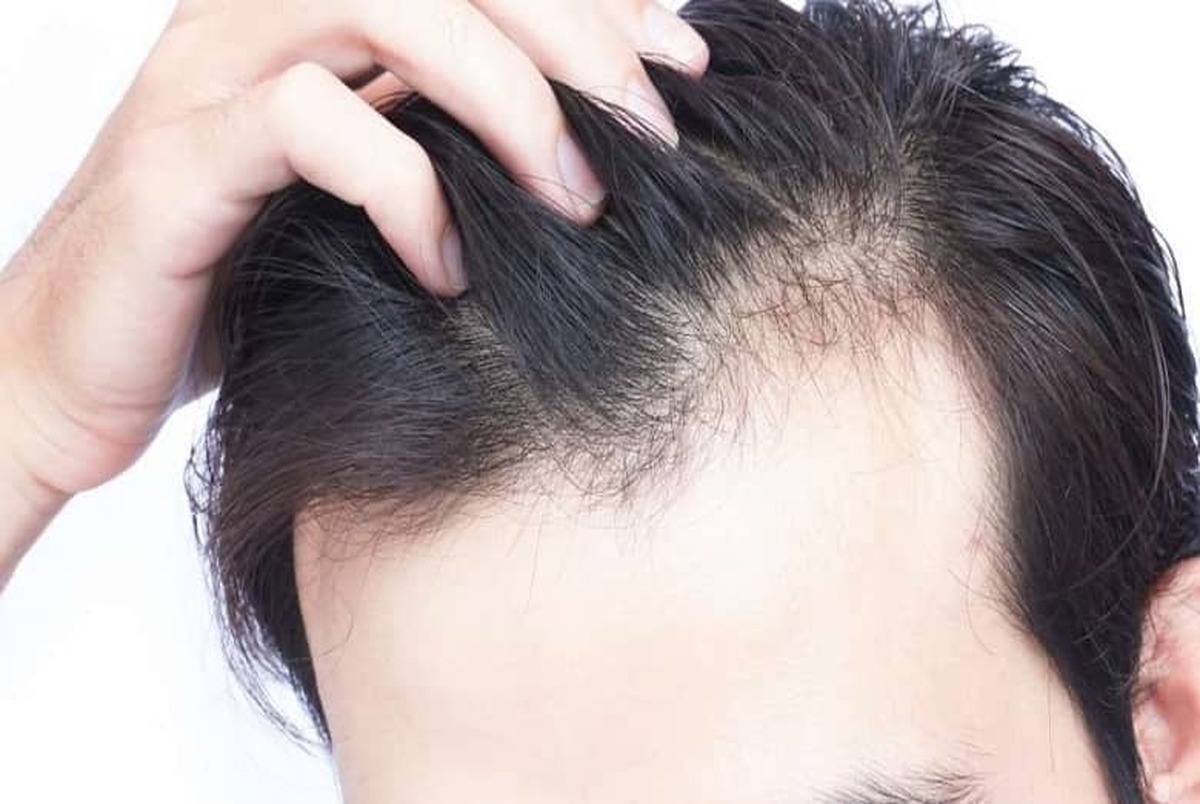 درمان ریزش مو با آب پیاز+نکاتی برای افزایش اثربخشی 


