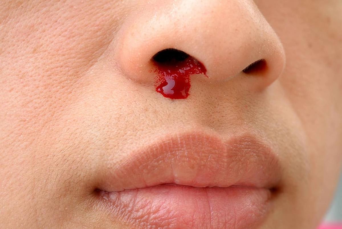 علت خونریزی مکرر بینی چیست؟