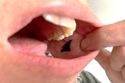 کنترل دیابت با چسباندن این پچ در دهان