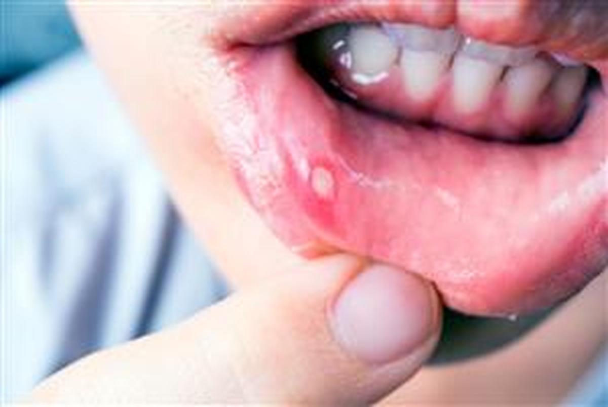 عاملی که می‌تواند آفت دهان را افزایش دهد