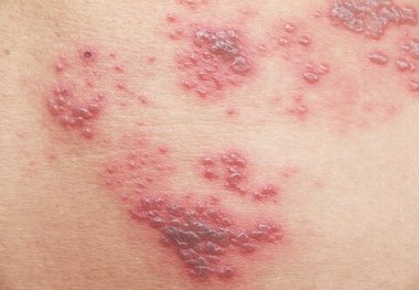 فردی که آبله‌مرغان نگرفته هم زونا می‌گیرد؟
