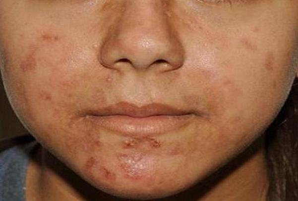 نکاتی که باید برای درمان آکنه بدانید
