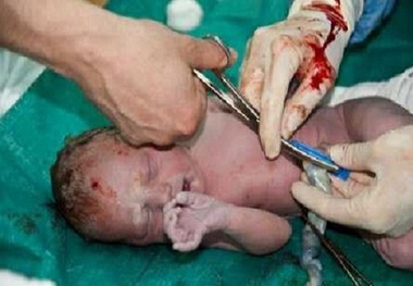 رتبه سوم خراسان رضوی در ذخیره سازی خون
بند ناف