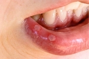 ارتباط برخی زخم های دهان و سرطان