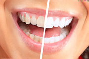 دلایل زرد شدن دندان چیست؟ / روش های خانگی از بین بردن زردی دندان