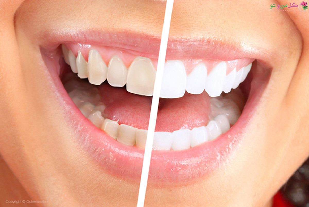 دلایل زرد شدن دندان چیست؟ / روش های خانگی از بین بردن زردی دندان