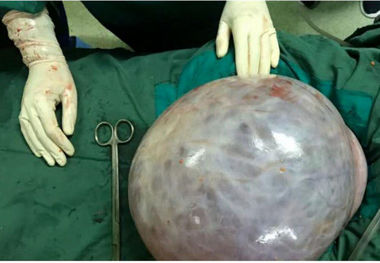 توده ۱۱ کیلویی در شکم یک بیمار در اردبیل/ عکس