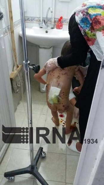کودک 5ساله بجنوردی از آی سی یو بیمارستان دکتر شیخ ترخیص شد