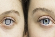 رابطه میان خشکی چشم و آسم چیست؟
