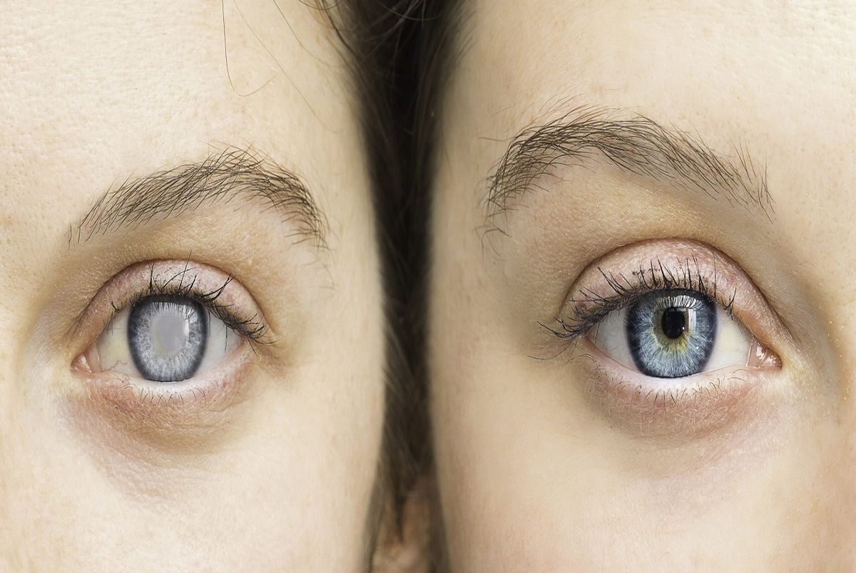 روشی جدید برای درمان خشکی چشم