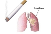 استعمال دخانیات اصلی ترین عامل سرطان ریه است