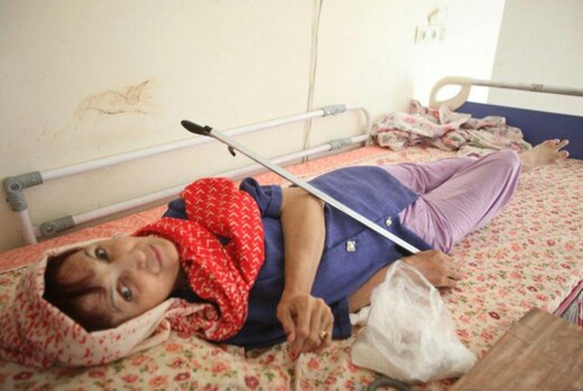 سرنوشت یک بیمار مبتلا به «FOP» در شیراز/ 40 سال جدال با مرگ