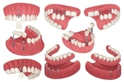 ایمپلنت دندان چه انواعی دارد؟ چه زمان پیشنهاد می‌شود؟