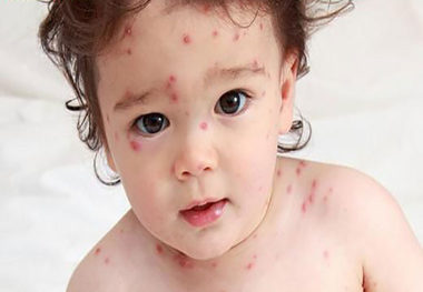 
چگونه به ویروس آبله مرغان مبتلا می‌شوید؟