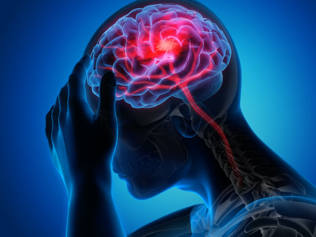 ردیابی سکته مغزی با کمک یک اپلیکیشن 
