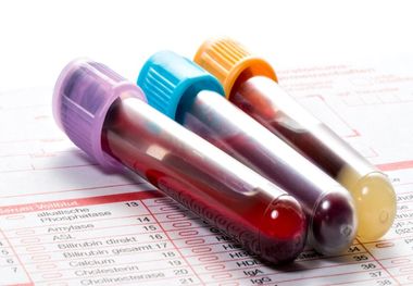 ۵۰ درصد علت ناباروری متوجه مردان است