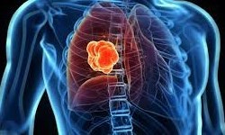 چرایی شیوع و علائم سنگ کلیه
